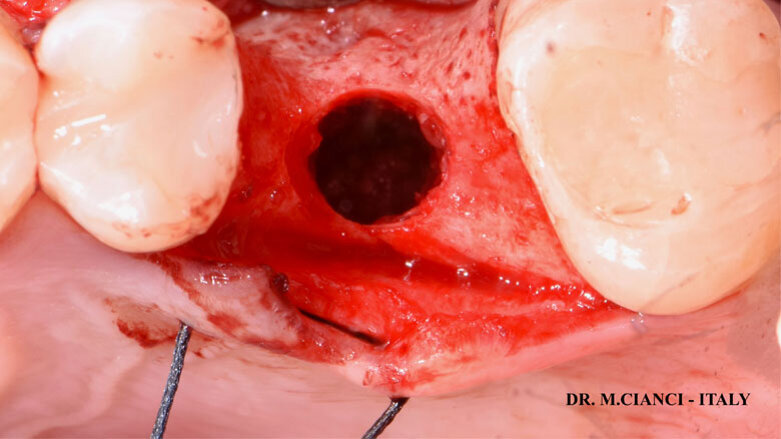 Impianto corto associato a carico immediato, Sinus lift e GBR con Endoret-PRGF su elemento singolo