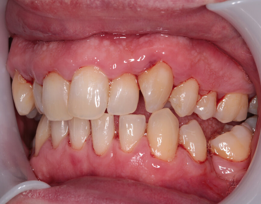 Fig. 8: Post-scaling right lateral view