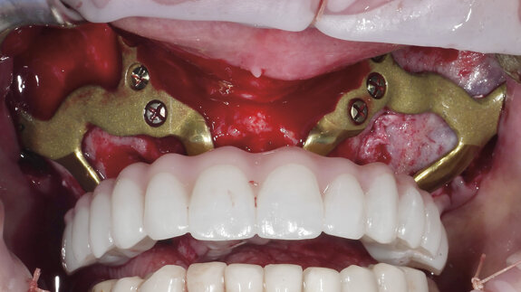 Quelle alternative à l’implantologie conventionnelle — implant zygomatique ou implant sous périosté ?