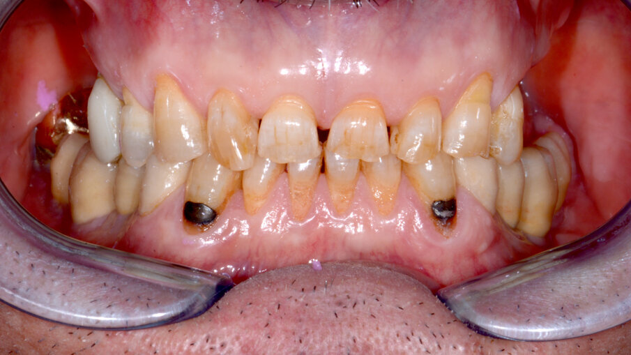 Obr. 13a–c: Intraorální snímky před ošetřením.