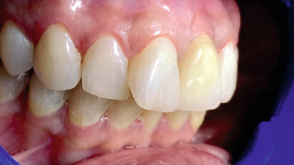 Mise en place immédiate dans la zone maxillaire intéressée par l’esthétique