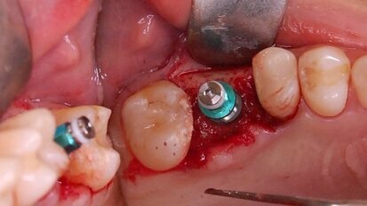 Małoinwazyjne podniesienie dna zatoki szczękowej z jednoczesną implantacją – opis przypadku