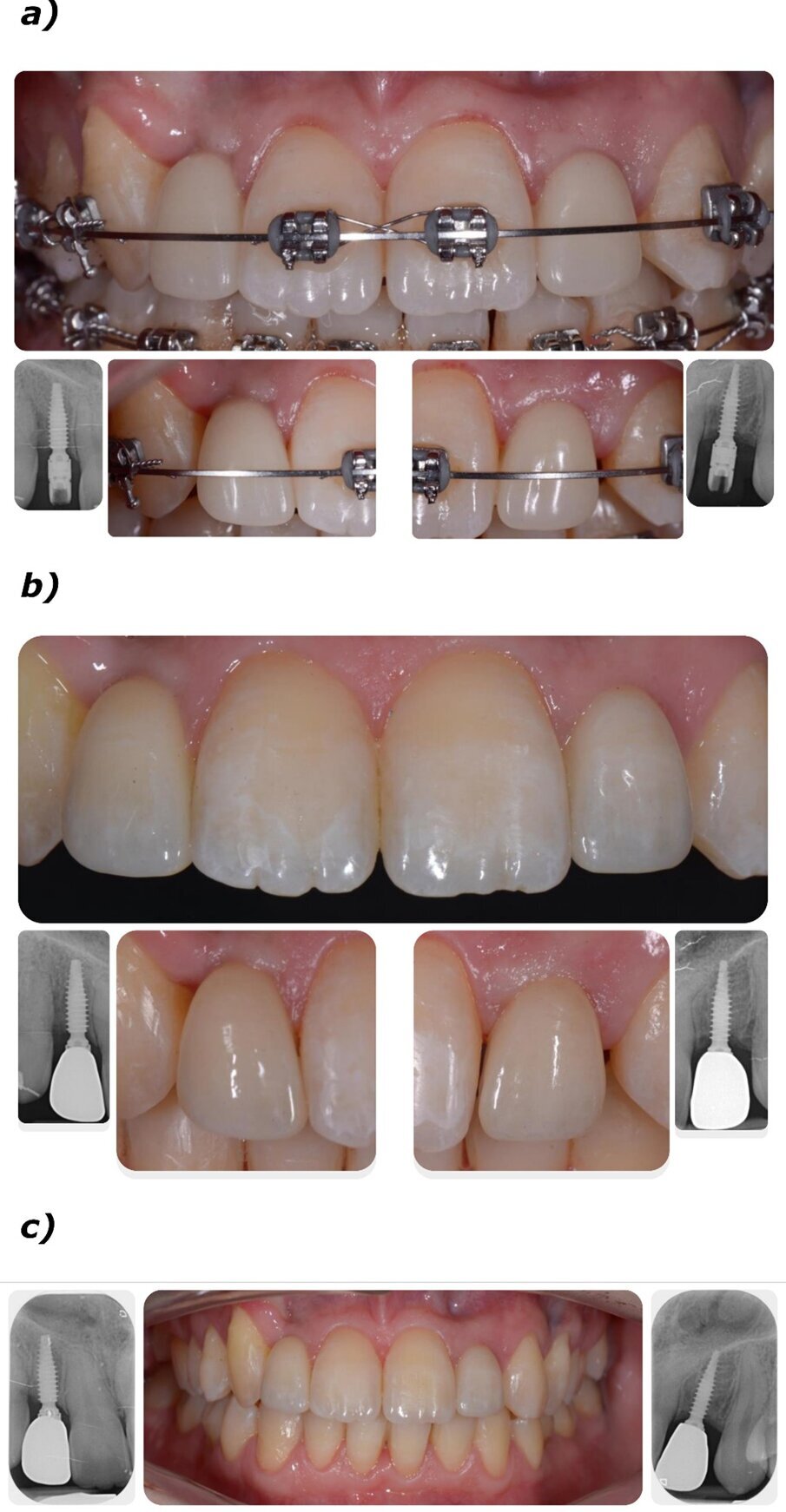 Fig. 5_Protesi provvisorie e definitive; a) protesi provvisorie e relative radiografie endorali; b) protesi definitive in zirconia multistrato e relative radiografie endorali a 60 giorni dalla consegna dei provvisori; c) controllo a 12 mesi dalla protesizzazione definitiva e radiografie endorali.