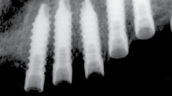 UIS IMPLADENTA – Use for all cases! Užití ve všech případech!