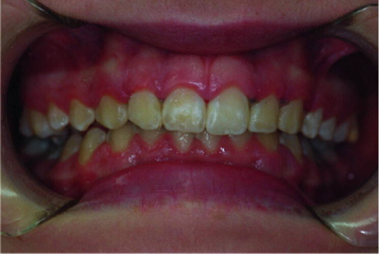 Healing five days after surgery.