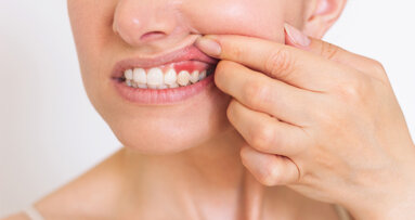 Intraoraler Biosensor ermöglicht frühes Screening auf Zahnfleischerkrankungen