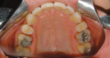 Posibilidades terapéuticas del CA® Clear-Aligner