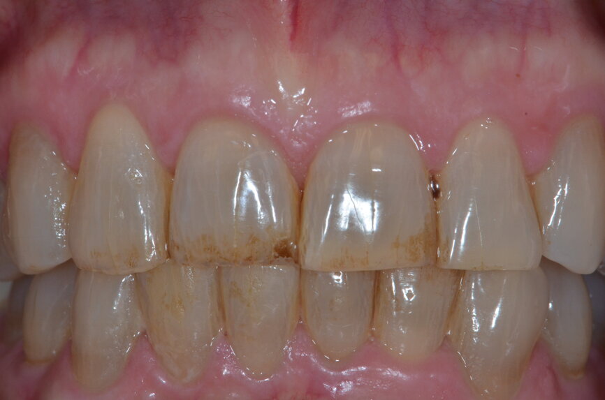 Fig. 13: Preoperative intra-oral photograph.