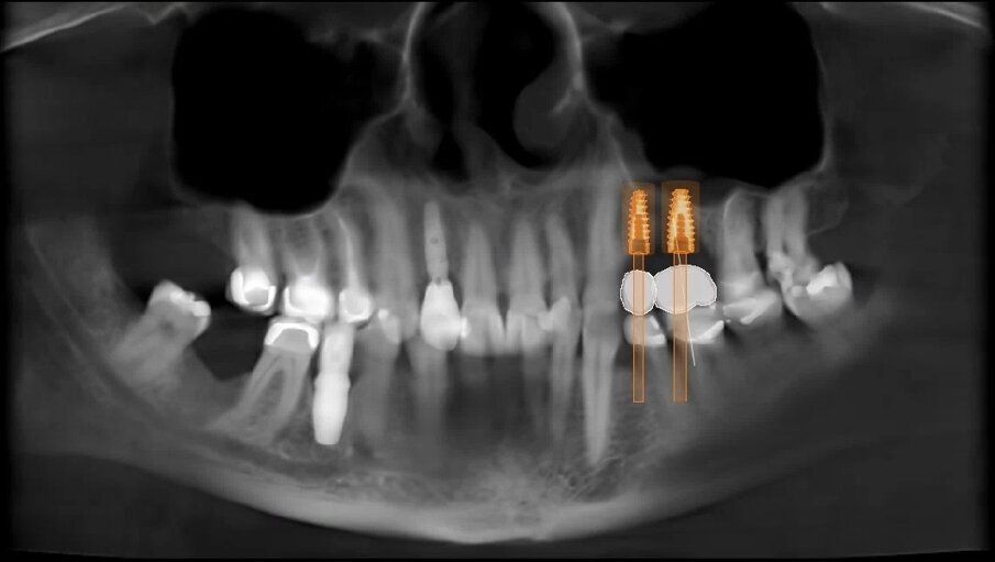 Fig. 10_Pianificazione finale in visione Panorex.
