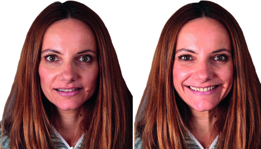 Fig. 2b: Extraoral photographs after orthodontic treatment.