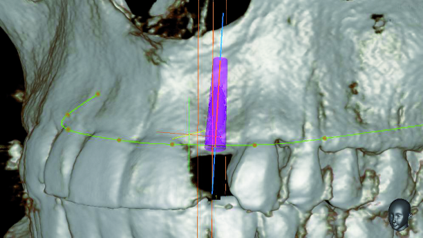 Lateral maxillary incisor implant – Key issues for aesthetic success