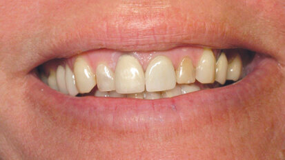 Estética en el sector anterior con un implante unitario Estética en el sector anterior con un implante unitario