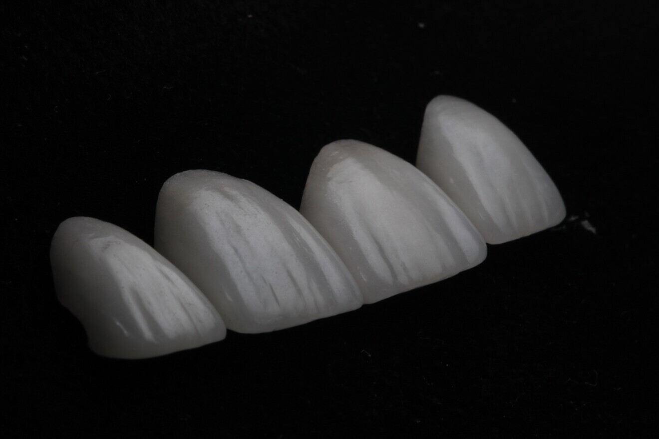 Fig. 2: Porcelain veneers.