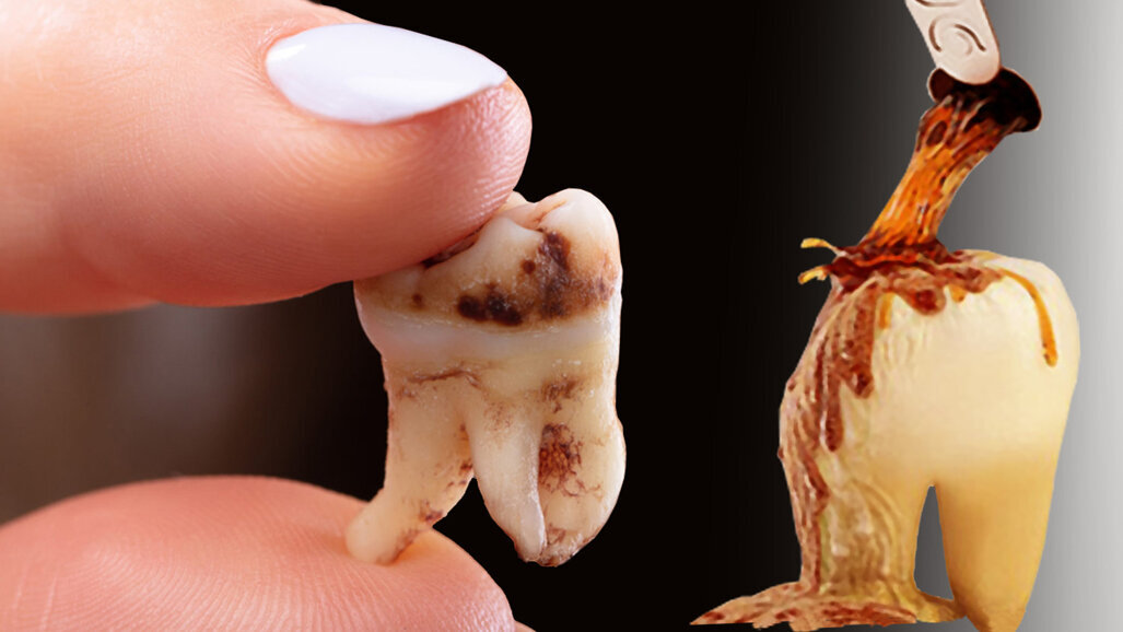 Study warns of tooth enamel erosion due to fizzy drinks