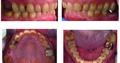 Case report: protesi adesiva di paziente con grave usura dentale. Follow-up a 4 anni