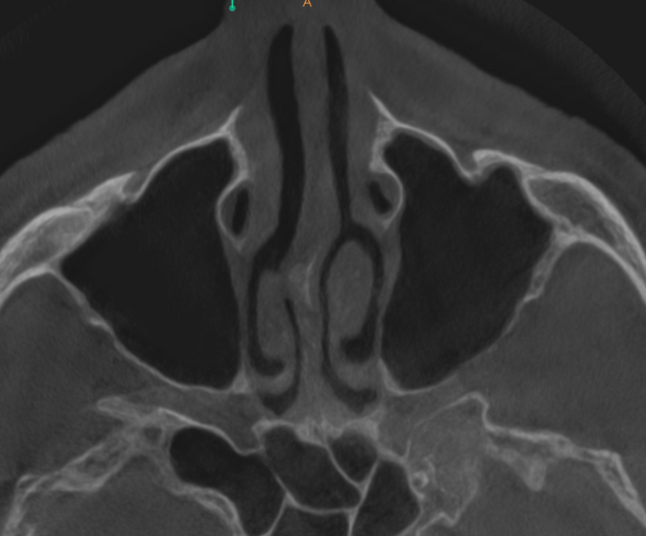 Fig. 9d: High-level transversal cross-section of the maxilla showing the completely healed maxillary sinus.