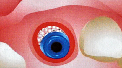 Impianti post estrattivi in siti infetti: un approccio clinico predicibile