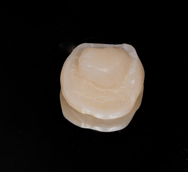 Fig. 8b: Milled resin composite endocrown after characterisation and polishing, intaglio surface.