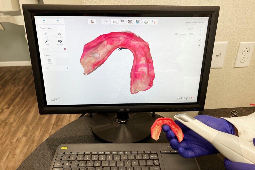 Scanning of the mandibular prosthesis.