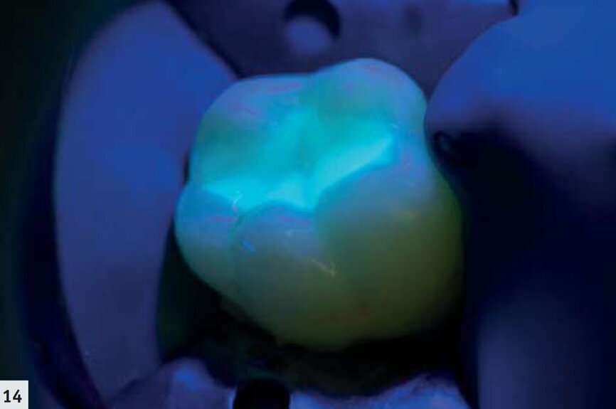 Fig. 14 : Restauration émettant une hyperfluorescence dans le proche-UV. Cette caractéristique facilite la vérification des limites marginales et l’élimination des anciennes restaurations défectueuses selon le concept d’intervention minimalement invasive. 