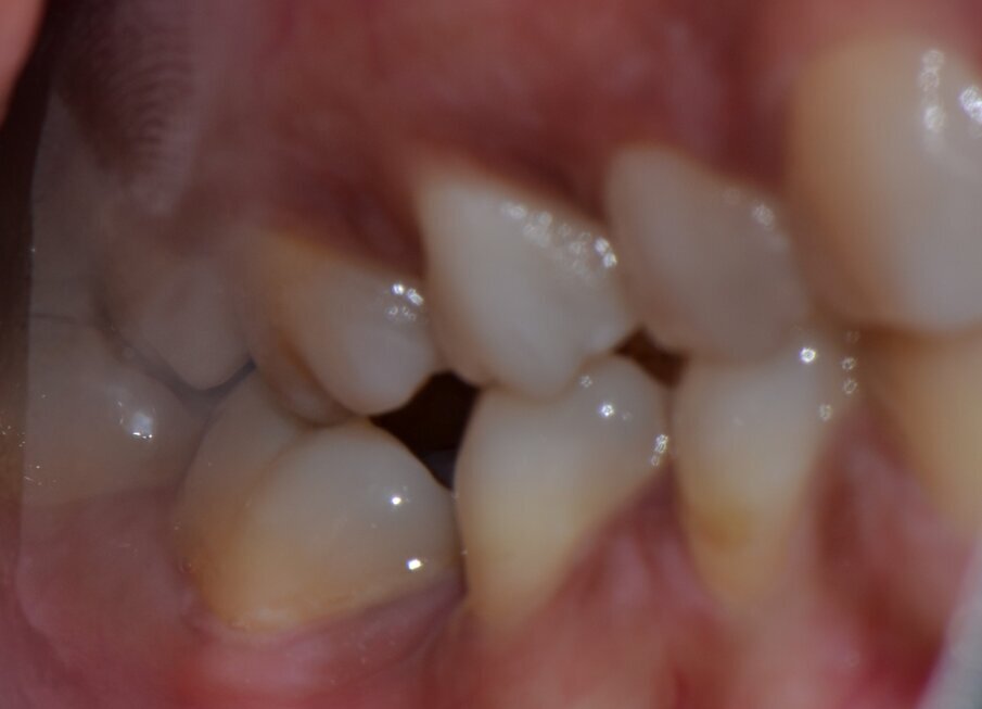 Fig 5: mesially tilted and rotated 47