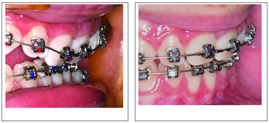 Fig. 6a. Patient S.V. with Class II div 2 and severe deep bite. Initial bonding disarticulated with anterior bite turbos showing the severely retroclined upper central incisors. Fig. 6b. Later in treatment showing torque control after the 0.018 x 0.0275 CN Ultima wire had been in four weeks. 