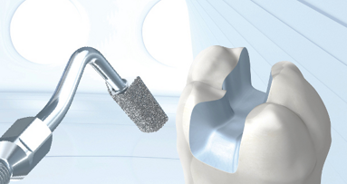 Изцяло керамичните възстановявания – уебинар засяга ключовите аспекти по темата: 19 септември 2013г.