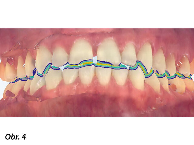 Znázornění okluze.