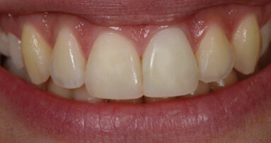 Stratification simplifiée en composite réalisée sous éclairage albédo LED D65 et sans scialytique