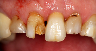 Доклад разкрива огромното разпространение на орални заболявания