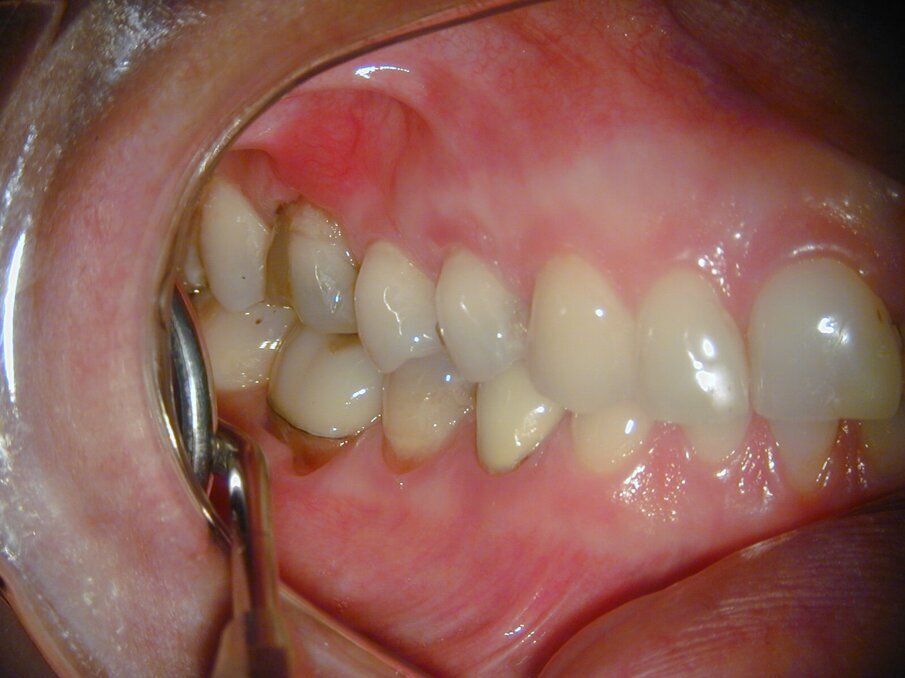 Afb. 9-11: Klinische foto’s van de 37-jarige follow-up