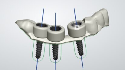 Prima operație dentară condusă de robot, a fost efectuată în China