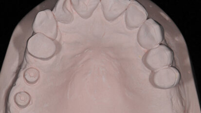 La rivoluzione delle impronte su impianti Encode® restorative system