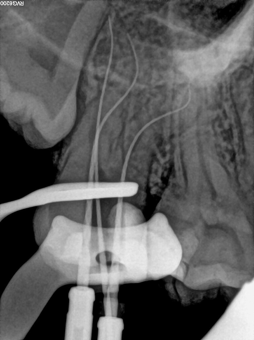Fig. 20: Length determination radiograph.