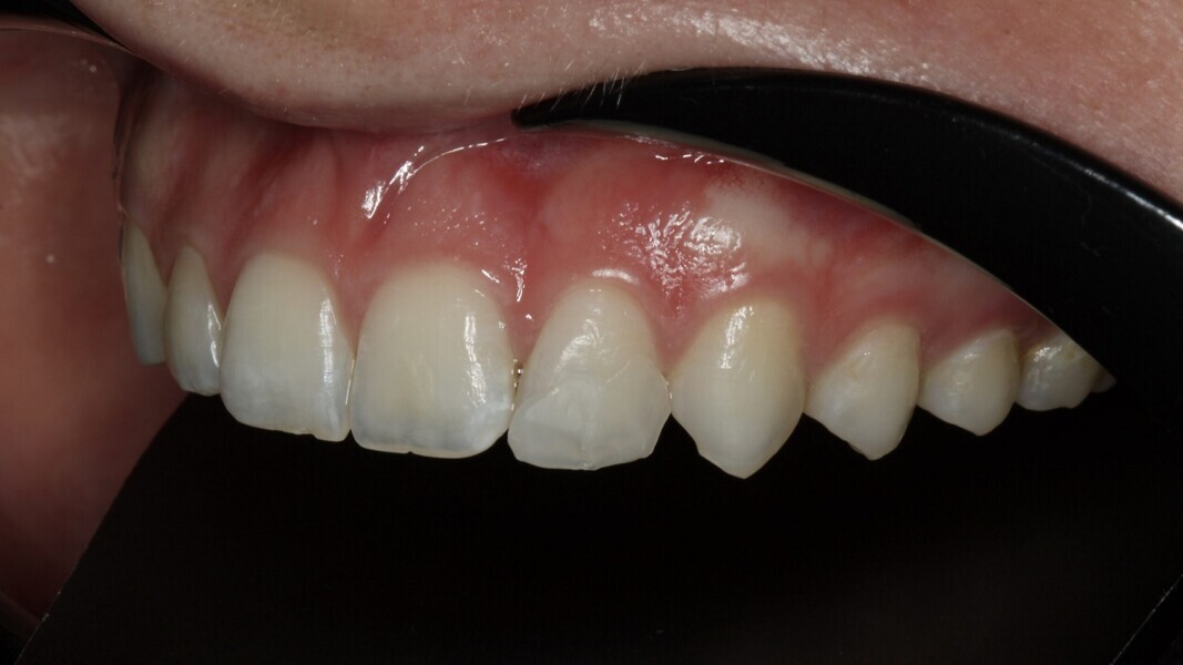 Fig. 5: Kleur bepalen met behulp van gewone en gepolariseerde fotografie. De kleur Bright past het best.