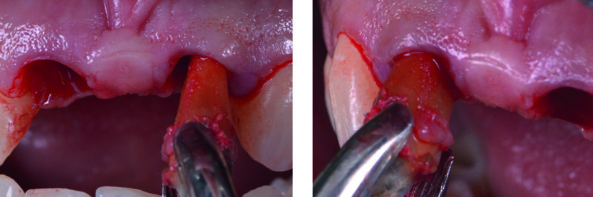 Fig. 12 : Extraction atraumatique des racines.