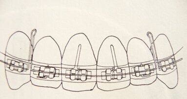 A review of the original Combination Technique and philosophy