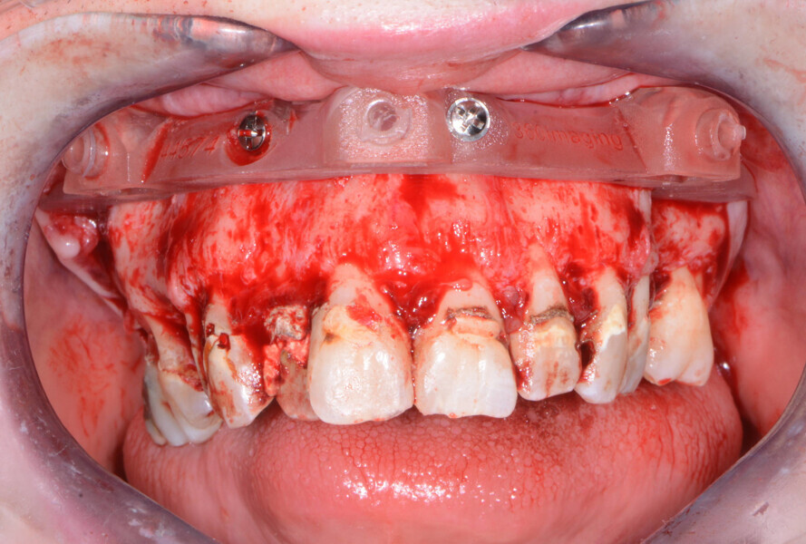 Fig. 7: Maxillary bone levelling foundation guide.