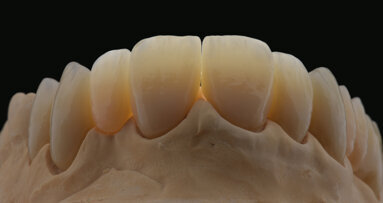 KATANA Zirconia restoration: Pretreatment for adhesive luting