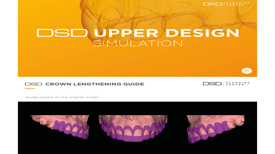Fig. 10_Progettazione della guida chirurgica.