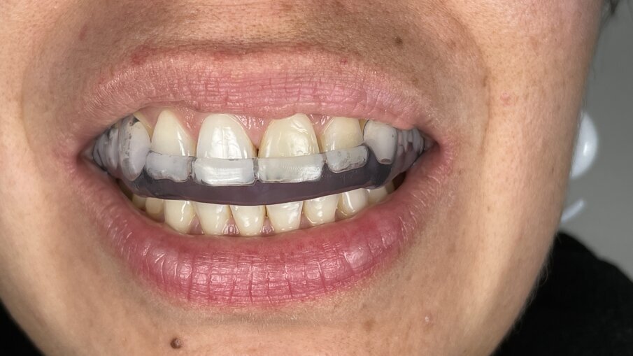 Obr. 10a–c: Hotová dlaha v ústech pacienta.