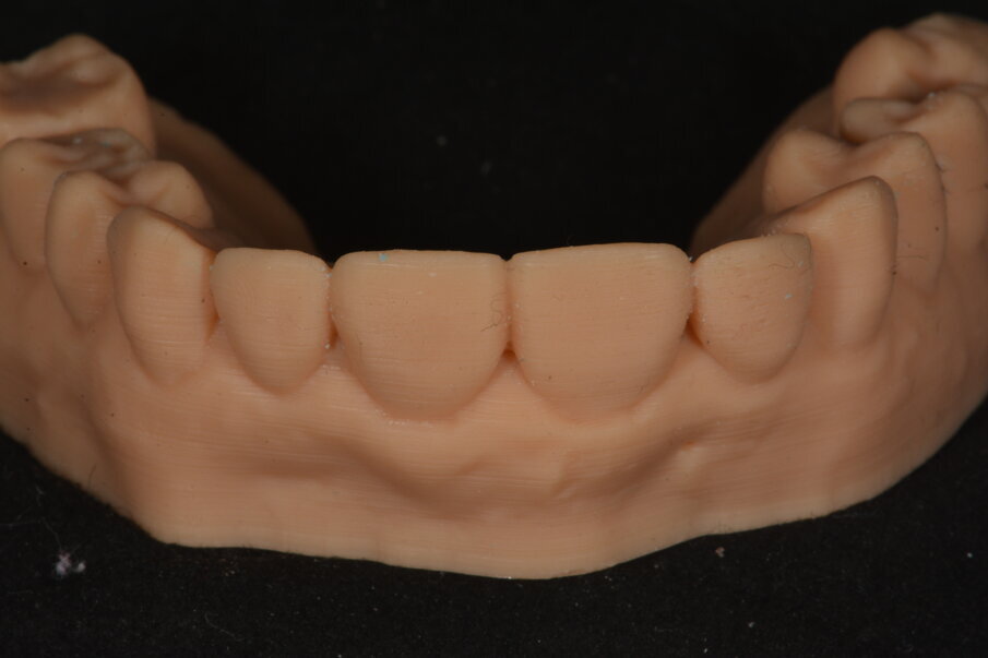 Een digitale afdruk werd genomen waar een digitale tandopstelling op werd ontworpen.