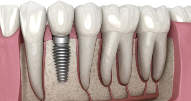 Dental implants market strengthens as digital dentistry and esthetic demand drive adoption