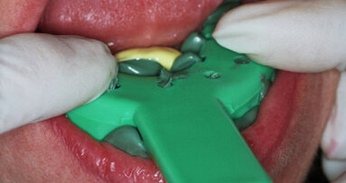 Asking your clinician for a new impression