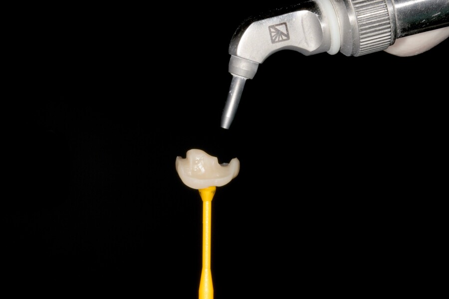 Fig. 22b: Sand-blasting of the intaglio surface of the endocrown.