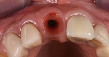 Risoluzione di un fallimento tardivo con impianto immediato e utilizzo di una lamina corticale ossea flessibile