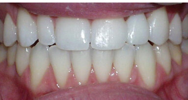 Dentists share their thoughts on veneers