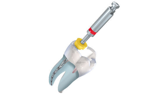 Webinar: Herausforderungen der Aufbereitung gekrümmter Wurzelkanäle