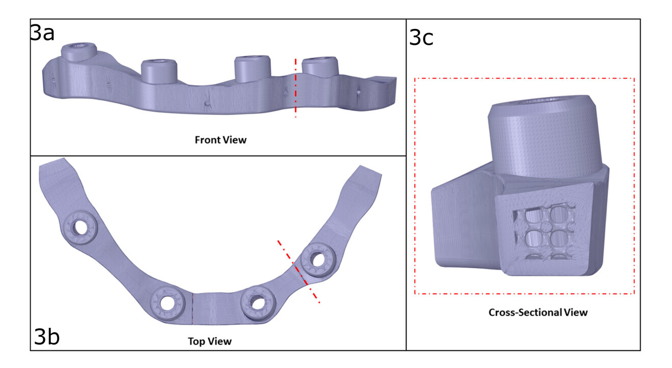 Figs. 3a–c: Implant bar design with circular cross-section internal lattice pattern. Frontal view (a). Top view (b). Cross-sectional view (c). (Image courtesy of © ADEISS)