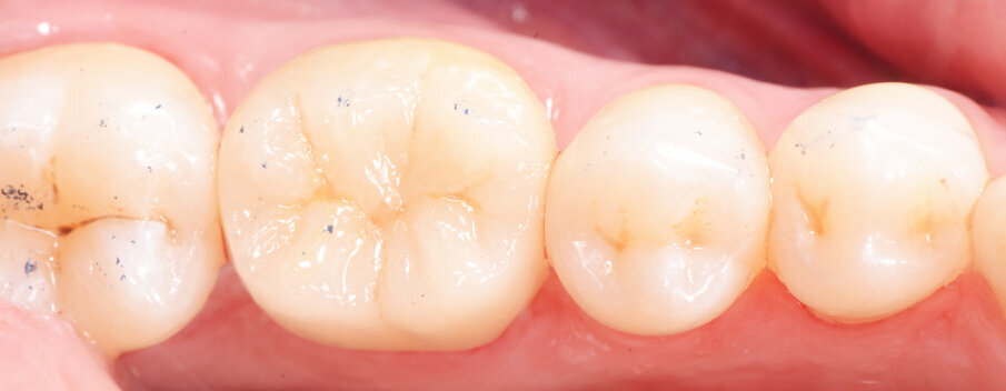 Fig. 12b: Lateral and occlusal view of the completed restoration